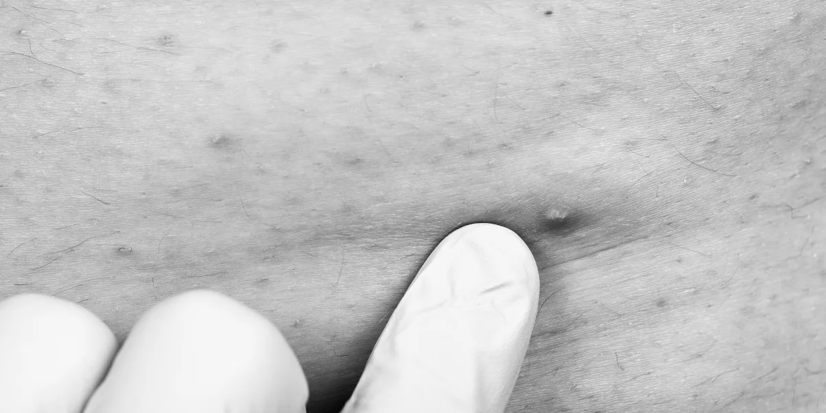 No momento, você está visualizando Foliculite no esporte: como evitar e tratar a inflamação dos folículos pilosos