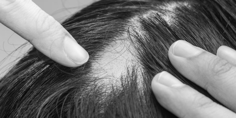 Leia mais sobre o artigo O que é a alopecia e como ela pode ser tratada? 